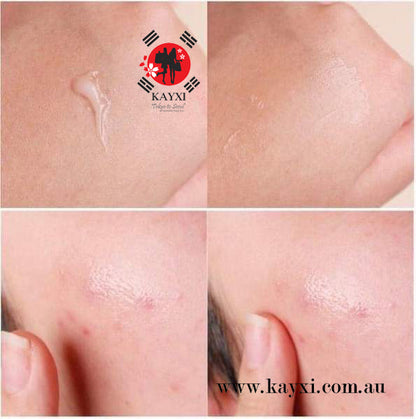 [Dong-A Pharmaceutical] Noscarna  Acne Treatment Gel 10g