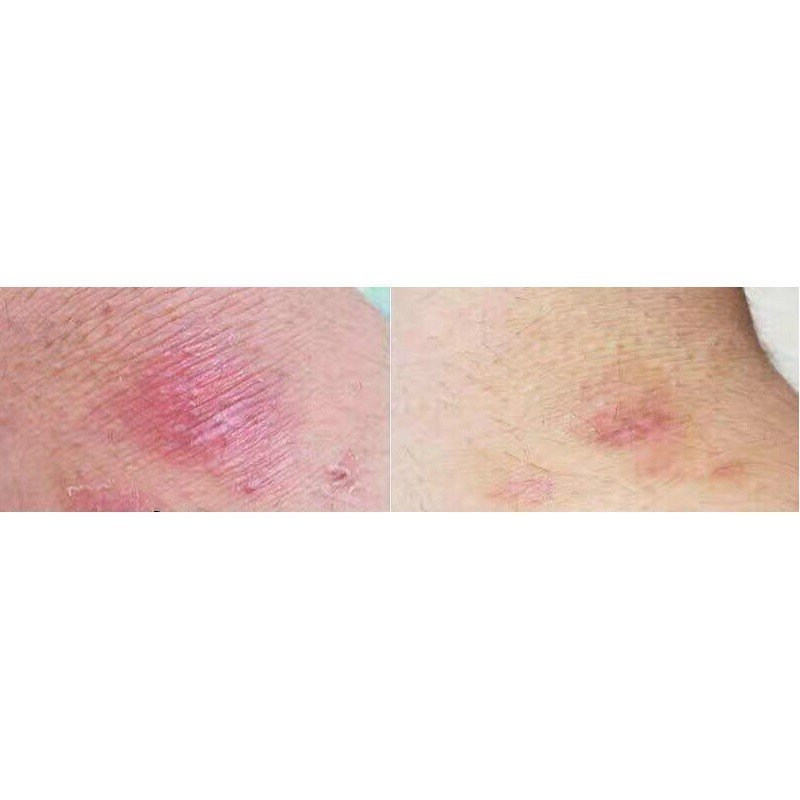 [Dong-A Pharmaceutical] Noscarna  Acne Treatment Gel 10g