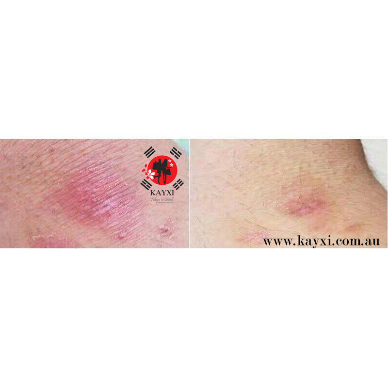 [Dong-A Pharmaceutical] Noscarna  Acne Treatment Gel 10g