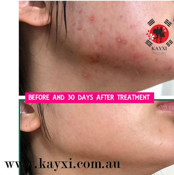 [SOME BY MI] AHA, BHA, PHA 30 Days  Miracle Cleansing Bar 160g